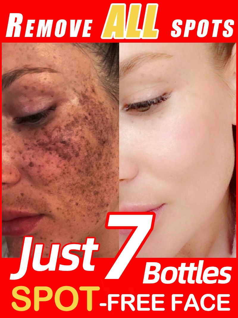 Lighten Freckles Melasma, Faci - đánh giá và giá Ultra Luxury Skincare